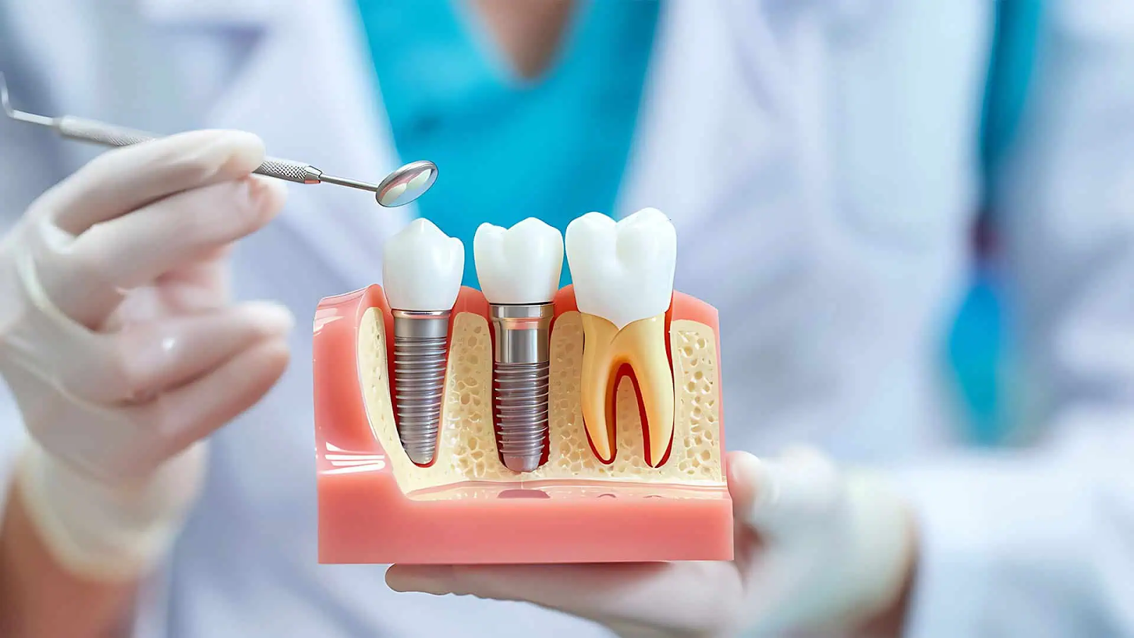 Discover 6 Must-Know Facts About Dental Implants_1