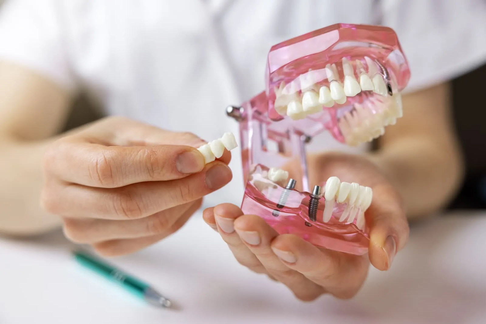 Your Guide To All-On-4 Dental Implants_5