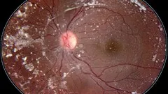 retinal-atlas-hereditary-chorioretinal-dystrophy-12417