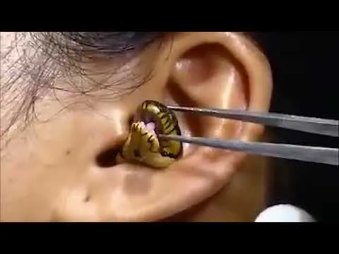 surgeon-struggles-to-remove-live-snake-from-womans-ear-in-viral-video-1767